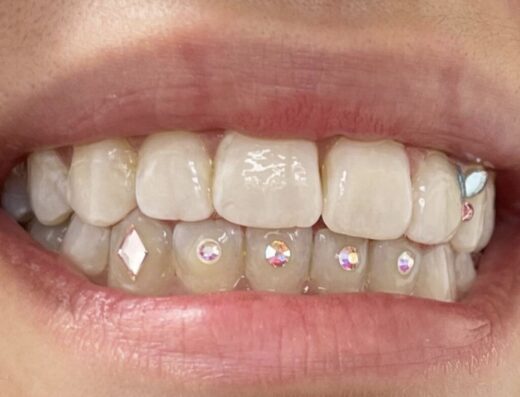New Shyne Whitening & Gem Service